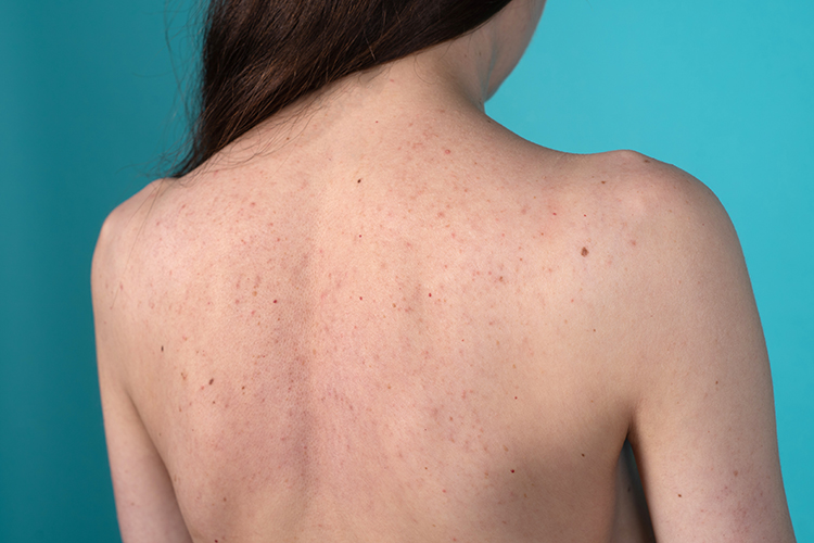 what causes back acne in females